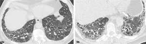 Patrón sugerente de otro diagnóstico: neumonitis por hipersensibilidad fibrótica Pérdida de la arquitectura pulmonar caracterizado por reticulaciones y bronquiectasias/bronquiolectasias por tracción asociadas a áreas de densidad en vidrio esmerilado y atenuación en mosaico.