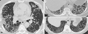 Enfermedad pulmonar interticial difusa con patrón sugerente de neumonía intersticial inespecífica (NII). Imágenes seleccionadas de TC de tórax en el plano axial, ventana pulmonar de dos pacientes Áreas de densidad en vidrio esmerilado, reticulaciones y bronquiectasias por tracción de predominio basal y peribroncovascular. 6c. Respecto subpleural paravertebral basal bilateral.