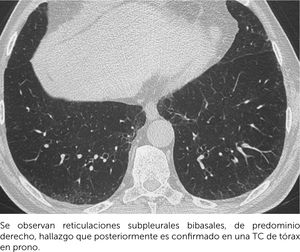 Anormalidades intersticiales pulmonares (ILAs). Imagen seleccionada de pielo-TC en paciente con cólico renal Se observan reticulaciones subpleurales bibasales, de predominio derecho, hallazgo que posteriormente es conﬁrmado en una TC de tórax en prono.