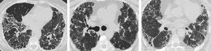Tomografía computarizada de alta (TCAR) con patrón de neumonitis por hipersensibilidad fibrótica (NHf).
