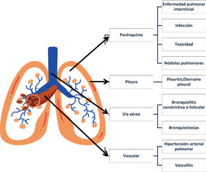 Afección pulmonar multicompartimental de la artritis reumatoide La artritis reumatoide puede afectar diversos compartimentos del pulmón, incluyendo vías respiratorias (bronquiectasias, bronquiolitis, cricoaritenoiditis), parénquima pulmonar (enfermedad pulmonar intersticial con patrones de neumonía intersticial usual (NIU), neumonia intersticial no especíﬁca (NINE, neumonía organizada (NO); nódulos reumatoides), pleura (pleuritis, derrame pleural) y vasos sanguíneos (hipertensión pulmonar, vasculitis). Adaptado de Carmona et al.8.