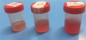 Lavado broncoalveolar (LBA) en hemorragia alveolardifusa (HAD) Se observa un incremento progresivo en el contenido hemático de las muestras obtenidas en alícuotas consecutivas, hallazgo característico de la HAD. El análisis del LBA revelará la presencia de eritrocitos y > 20% de hemosiderófagos, conﬁrmando el diagnóstico de HAD.