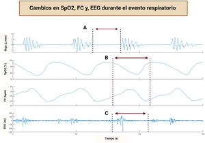 Cambios en SpO2, FC y, EEG durante el evento respiratorio La figura muestra el flujo ventilatorio (l/min), saturación de oxígeno (SpO2%), frecuencia cardíaca (FC) y señales electroencefalográficas (EEG). La figura A muestra la disminución del flujo respiratorio durante un evento respiratorio mientras que la figura B muestra el efecto disruptivo sobre la SpO2% y FC. Adicionalmente, en la figura C se puede observar un incremento de la actividad EEG, interpretándose como arousal.