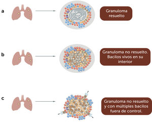 Tipos de granulomas.