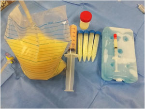 Líquido pleural obtenido en una pleurocentesis diagnóstica y terapéutica Pleurocentesis diagnóstica distribuida en distintos tubos para análisis. Pleurocentesis terapéutica 1 500ml aprox.