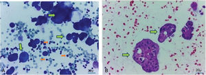 Citología positiva para adenocarcinoma en líquido pleural A) Citología de líquido pleural teñida con Giemsa, fondo linfoide (ﬂechas naranjas), células grandes de adenocarcinoma (ﬂechas verdes); B) Bloque celular de la misma. Aumento 40×.
