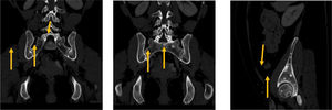 Tomografía computarizada de pelvis, reconstrucción coronal-sagital con ventana ósea. Múltiples lesiones (flechas amarillas) enostóticas osteo-escleróticas acetabulares, ilíacas bilaterales y sacras, sugerentes de osteopoiquilosis.
