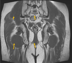 Resonancia magnética pélvica reconstrucción coronal con secuencia potenciada en T1. Varias lesiones hipointensas sacro-ilíacas bilaterales (ﬂechas amarillas) que se corresponden con presencia de hueso maduro, que demuestran estabilidad en número y tamaño de focos enostóticos.