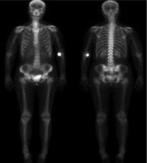 Gammagrafía ósea en 2 proyecciones: anterior y posterior. En ella, no se aprecia hipercaptación de los focos de enostosis ósea anteriormente descritos. Sin embargo, se ve un punto hipercaptante en fosa antecubital izquierda, que es por donde se ha inyectado el radiotrazador; así como en la vejiga, dada su eliminación por orina, sin constituir por ello, puntos de hipercaptación patológica.