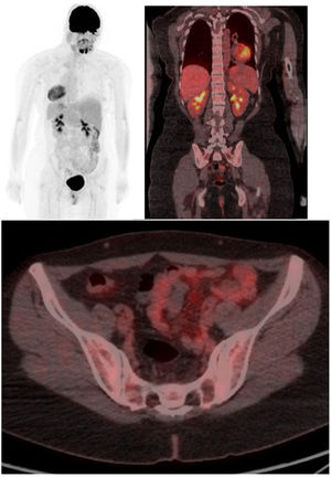 Tomografía por emisión de positrones (PET/TC) con fluorodesoxiglucosa F-18 (FDG) de cuerpo entero con reconstrucción con proyección de máxima intensidad (MIP), coronal y axial fusionados Se aprecian focos de captación ﬁsiológica como son cerebro, corazón, ambos riñones y vejiga y ausencia de captaciones ósea patológicas, lo que lo diferencia de metástasis u otras enfermedades óseas sugerentes de malignidad.