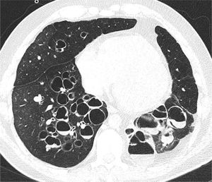 Paciente de 39 años con antecedentes de infección por adenovirus en la infancia Se observan bronquiectasias bilaterales con presencia de niveles hidroaéreos (imagen con autorización de paciente).