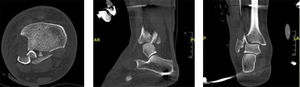 Tomografía computarizada de tobillo posterior a fijación externa. Corte axial, sagital y coronal. Se observa persistencia de traslación lateral del talo con interposición de fragmento de fíbula en el rasgo del maléolo posterior.