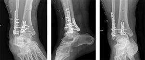 . Radiografías de tobillo posterior a reducción abierta y fijación interna. Proyección en mortaja, lateral, anteroposterior (AP). Imágenes post quirúrgicas luego de segunda intervención con reducción y osteosíntesis de fíbula y maléolo posterior con placas e fijación rígida de la sindesmosis.