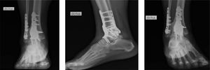 Radiografías de tobillo posterior a artrodesis tibiofibular+artrodesis tibiotalar. Proyección en mortaja, lateral, anteroposterior. Imágenes post quirúrgicas luego de tercera intervención con artrodesis tibiotalar con placa.