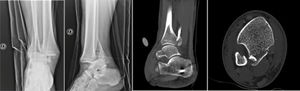 Radiografías y tomografía computarizada de luxofractura de Bosworth. A y B: radiografía de tobillo en proyección AP y lateral, respectivamente, donde se evidencia luxofractura trimaleolar. C y D: tomografía computarizada en cortes sagital y axial, respectivamente, donde se observa fragmento proximal de fíbula interpuesto en foco de fractura de maléolo posterior.
