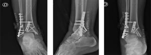Radiografías de tobillo posterior a reducción y osteosíntesis. Radiografía de tobillo. Proyección en mortaja, lateral AP, luego de reducción y osteosíntesis de luxofractura de tobillo mostrada en la figura 4.