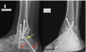 Proyecciones lateral y mortaja en carga de tobillo izquierdo, donde se aprecia artrodesis tibio talar con tornillos ya consolidada; y artrodesis subtalar con 2 tornillos retrógrados (flecha roja) convergentes, no consolidada (flecha amarilla).