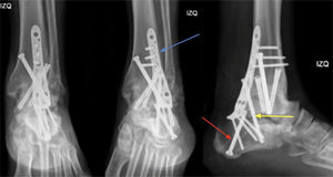 Proyecciones anteroposterior, mortaja y lateral de tobillo izquierdo. Resultados post op cirugía de revisión. Se aprecia aumento de la rigidez de constructo mediante una placa posterior tibiocalcánea (flecha azul), tornillo compresión interfragmentario a través de la placa (flecha amarilla)+tornillo calcáneo talar retrógrado (flecha roja).