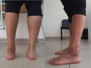 Control clínico 2 meses post operatorio, donde se evidencia adecuada alineación del retropié y buena tolerancia a la carga.