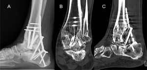 A. Radiografía lateral en carga de tobillo izquierdo con adecuado posicionamiento de elementos de osteosíntesis. B y C. Tomografía axial computarizada en cortes coronales y sagitales con signos incipientes de consolidación.