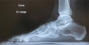 Radiografía de pie derecho. Proyección lateral con carga. Lesión osteolítica con calcificación central sin signos imagenológicos de agresividad en calcáneo de pie derecho.