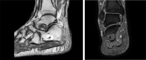 RM de pie derecho. Secuencias T2 sagital y PDwFS (proton density with fat suppression) coronal con lesión ósea medular central con señal de grasa e imagen central de baja señal de aspecto cálcico, sin signos imagenológicos de agresividad.