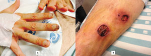 Punctiform necrotic ungueal lesions (A) and large necrotic ulcers in the right leg (B).