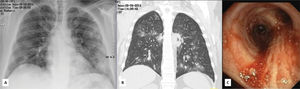 Bilateral inﬁltrates and cavitating micronodules in X-ray (A) and CT (B); pulmonary hemorrhage in bronchoscopy (C).
