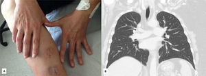 After cytotoxic therapy, regression of the cutaneous lesions (A) and pulmonary cavitations (B).
