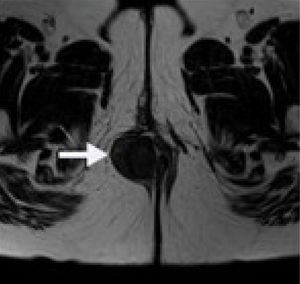 Resonancia magnética nuclear de pelvis que muestra una lesión compatible con leiomioma anal extraesﬁnteriano.