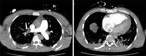 Angiotomografía pulmonar. No se observa tromboembolismo pulmonar, relación ventrículo derecho/ventrículo izquierdo aumentada, mayor a 1 (día de ingreso).