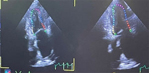 Ecocardiograma transtorácico con presencia de engrosamiento de las paredes ventriculares, disfunción diastólica, aumento en la ecogenicidad, engrosamiento del tabique interauricular y alteración en el strain longitudinal, hallazgos compatibles con miocardiopatía amiloidea.