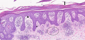 Microfotografía en tinción hematoxilina-eosina (HE) con aumento 10X de muestra de piel afectada. Se observa hiperqueratosis paraqueratósica continua (ﬂecha), hiperplasia de la epidermis con elongación de las crestas (estrella). Aplanamiento de la epidermis en las zonas suprapapilares (x). En dermis se aprecia un denso inﬁltrado linfocitario perivascular (rodeado por una elipse).