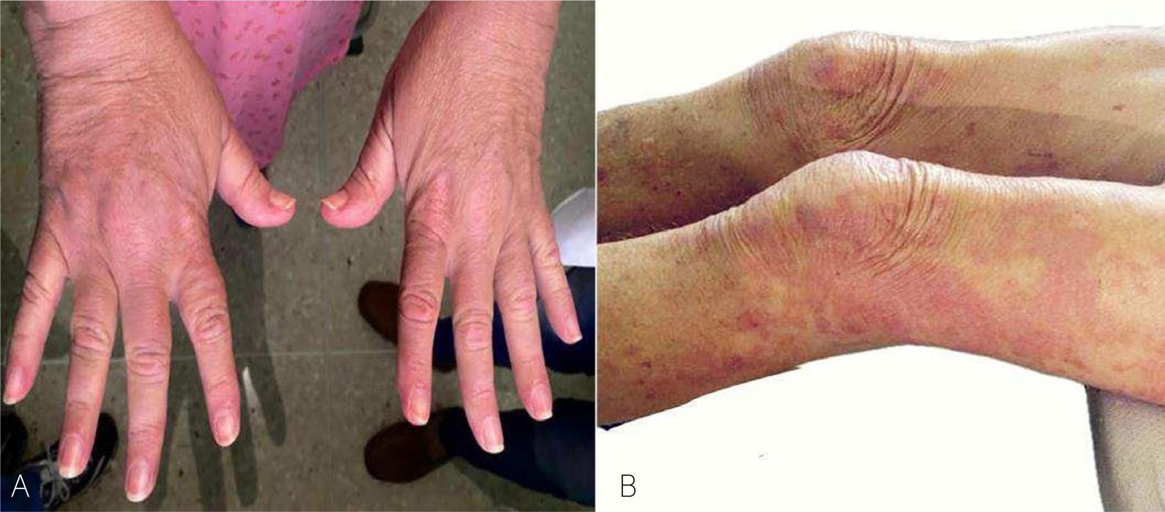 Dermatomiositis clásica. Reporte de un caso | Revista Médica Clínica ...