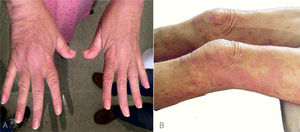 Se observa las pápulas de Gottron en las extremidades superiores e inferiores. En 1 A, se observa las pápulas de Gottron a nivel de nudillos, con telangiectasias en pliegue ungueal. En 1 B se observan las pápulas de Gottron en las rodillas asociado a edema y signo de la pistolera en muslos.