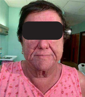 Se aprecia el eritema en heliotropo en rostro, cuello y del escote.