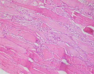 Infiltración endomicial por células inflamatorias y fibras musculares atróficas con cambios regenerativos (hematoxilina - eosina, x10).