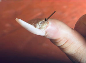 Foto de pulgar derecho de la paciente donde se evidencia úlcera periungueal con bordes irregulares (flecha).
