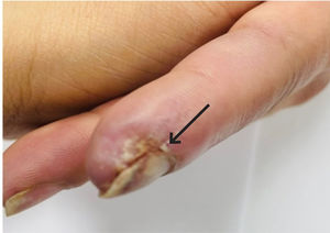 Foto de índice de mano izquierda del paciente que muestra úlcera en curación dejando leve depresión del pulpejo (flecha).