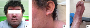 (A) facial edema and erythroderma; (B) preauricular and auricular edema; (C) purpura in foot.