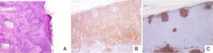 Skin and lymph node biopsies. (A) cutaneous biopsy (40x), with hematoxylin-eosin stain showing psoriasiform spongiotic and vacuolar dermatitis, mid and superficial perivascular eosinophilic infiltration and lymphocyte-perivascular infiltration (B) immunohistochemistry in optical microscopy (10x), left cervical lymph node showing follicular hyperplasia and intense TCD3+ clonal expansion in the parafollicular zone (C) immunohistochemistry in optical microscopy (10x) with atypical CD30+ lymphocytes with Sternbergoid aspect.