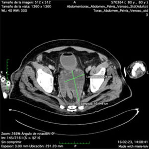 Tomografía computarizada de abdomen y pelvis a los 23 días posterior a ingreso. Se observa colección periprostática con aumento de volumen.