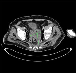 TC de abdomen y pelvis a los 41 días posterior a ingreso. Se observa colección periprostática con disminución de volumen tras inicio de terapia farmacológica.