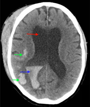 TC al ingreso hospitalario Imagen muestra hidrocefalia (flecha roja), lesiones hemorrágicas intraparenquimatosas (flechas verdes). y hemorragia intraventricular (flecha azul) al ingreso hospitalario.