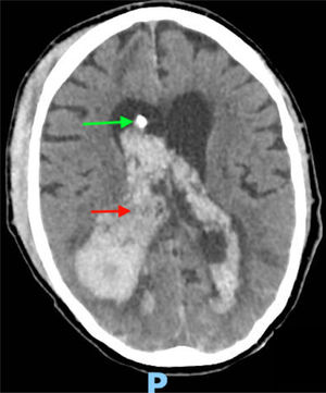 TC con drenaje ventricular externo derecho Imagen muestra ubicación de drenaje ventricular externo situado en asta frontal de ventrículo lateral derecho (flecha verde) y evolución de hemorragia intraventricular (flecha roja).