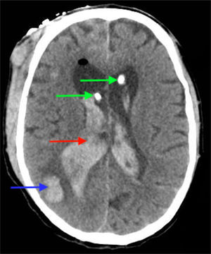 TC con drenaje ventricular externo bilateral Imagen muestra drenaje ventricular bilateral (flechas verdes), hemorragia intraparenquimatosa (flecha azul) y evolución de hemorragia intraventricular (flecha roja).