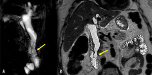 Quiste de colédoco tipo 3 según la clasificación de Todani. A: Colangioresonancia que muestra coledococele. B: Resonancia magnética de abdomen que muestra coledococele.