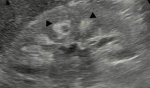 Evidencia de nefrocalcinosis en ultrasonido en paciente de 33 años con XLH, tratado crónicamente con sales de fosfato y calcitriol.