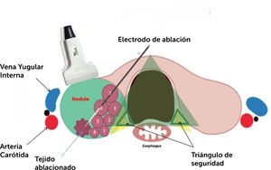 Esquema de ablación por radiofrecuencia, abordaje transístmico.