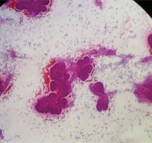 Citología tiroidea con formaciones papilares (tinción hematoxilina-eosina).